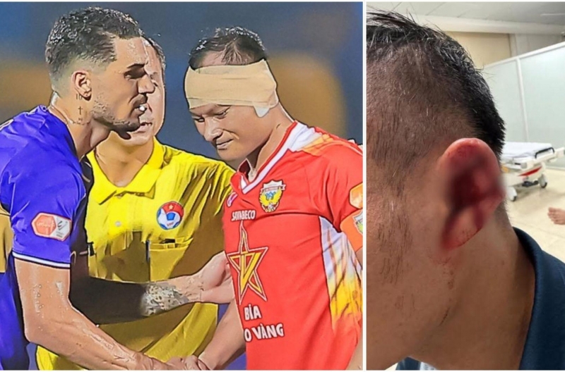 Trọng Hoàng suffered a serious injury after a collision with Hoàng Hên.